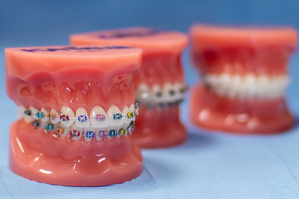braces - gap in teeth - 3Dental